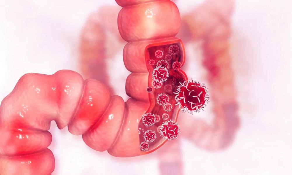 Έρευνα: Η κατανάλωση λιπαρών και σακχάρων προκαλεί φλεγμονές στο έντερο